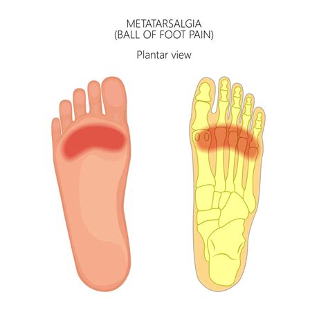 Metatarsalgiametatarsal Pain Caruso Foot And Ankle
