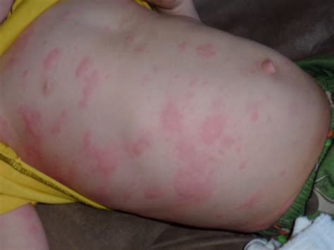 Here are allergy rash home remedies. Clausen in the Hausen & out in the Garden: rash two hours ...