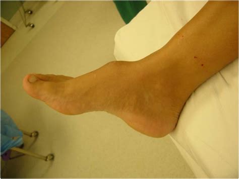 Common locations for bone spurs are in the back, or sole, of the heel bone of the foot, around joints that have degenerated cartilage, and in the spine adjacent to. Leiomyosarcoma
