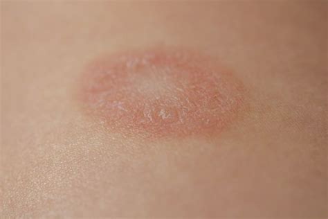 What Causes A Maculopapular Rash Facty Health