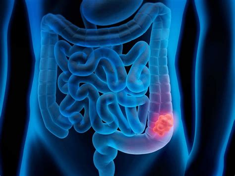 Colorectal Cancer Scientists Find A Way To Stop Colorectal Cancer