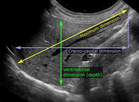 Abdominal Ultrasonography Of The Liver As A Sagittal Plane Through The