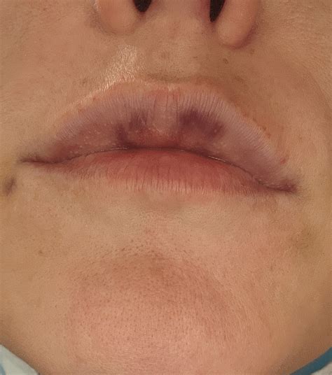Lip Filler Post 48 Hours Does This Look Like Vascular Occlusion Rcosmeticsurgery