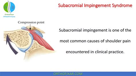 Subacromial Impingement Syndrome Orthofixar The Best Porn Website
