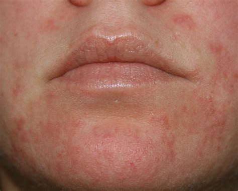 Red Scaly Patches On Face Pictures Photos