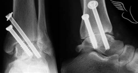 Arthroscopic Ankle Fusion The Foot And Ankle Clinic