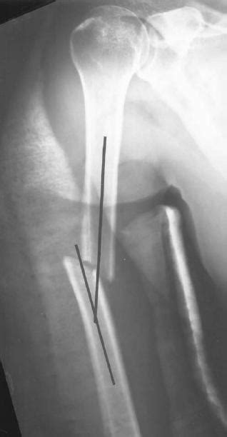 Common Orthopaedic Terminology and General Fixation ...