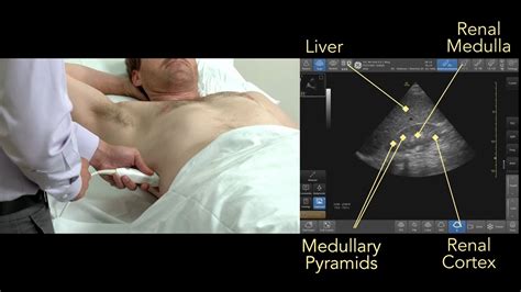 Point Of Care Kidney And Bladder Ultrasound YouTube