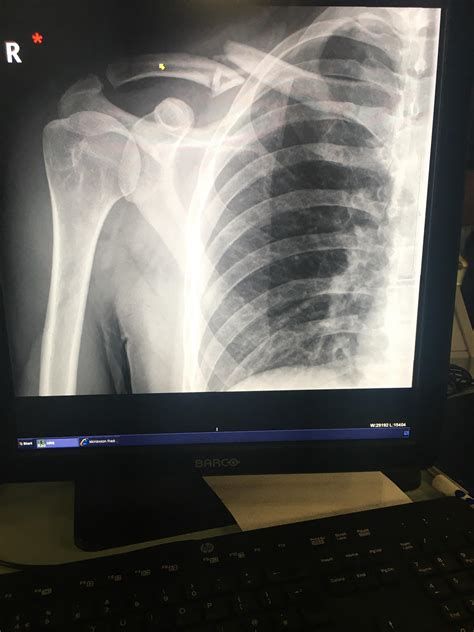 My Broken Collarbone Any Tips For Helping This Heal The Doctors At