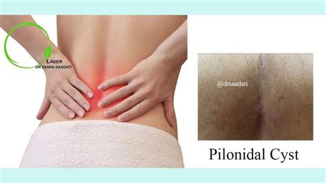 What Are Pilonidal Cysts دکتر زهرا سعادتی