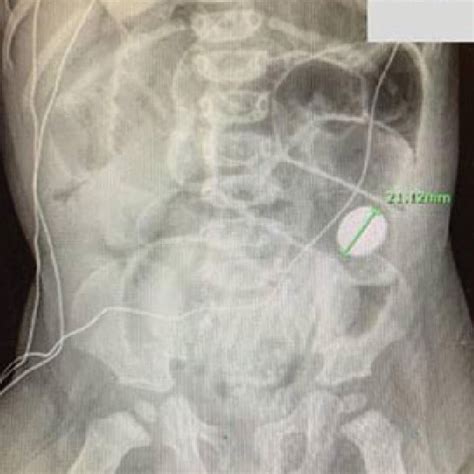 Kub X Ray On Postoperative Day 5 A 21 Mm Disc Battery Is Located In