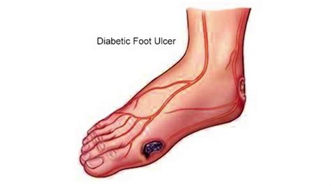 Diabetic Foot Care Wounds And Ulcers American Foot And Leg Specialists Youtube