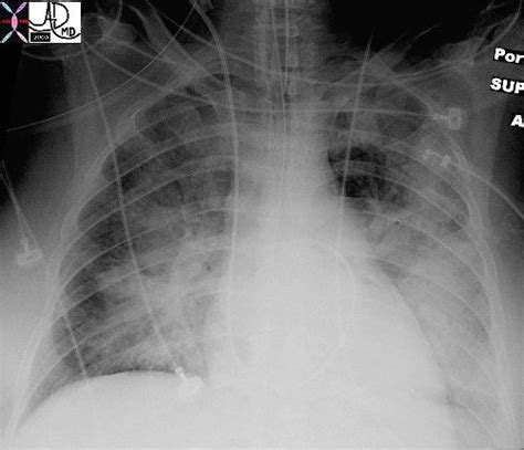 Batwing Appearance In Chf On Cxr Lungs