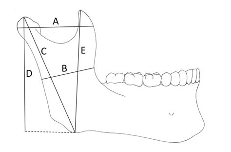 Variables Measured In The Mandibular Ramus A Maximum Ramus Breadth