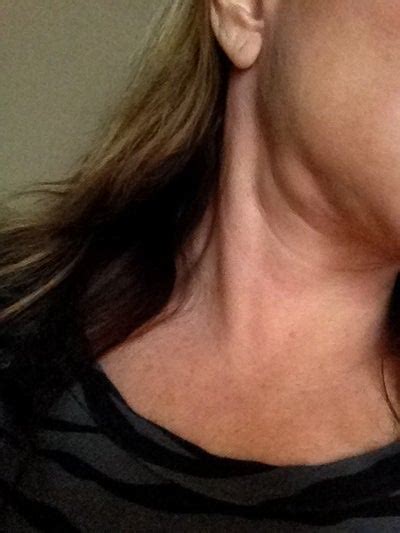 Swelling From Lymphs Or Glands On Both Sides Of My Neck That Are