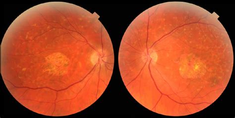 Dots Spots And Other White Retinal Lesions Page 37 Of 61 Retina