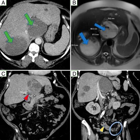 A Abdominal And Pelvic Ct With Iv Contrast Showing 2 Large Hepatic