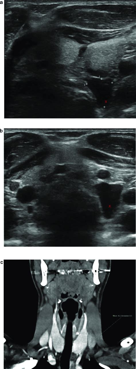 Cystic Parathyroid Gland A Transverse Ultrasound Images Through