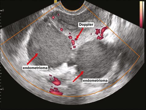 √ uterus endometriosis ct scan tumors of the uterine corpus clinical gate the best way to