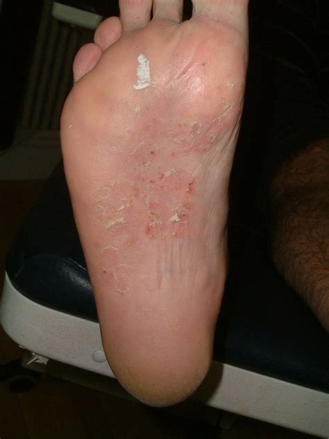 Fungal Skin Podiatry South Belfast Date