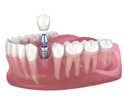 Multiple Dental Implants In North Phoenix In Chandler And North Phoenix