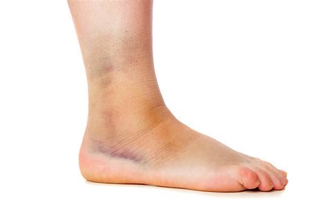 Bruised Ankle Stock Photos Pictures And Royalty Free Images Istock