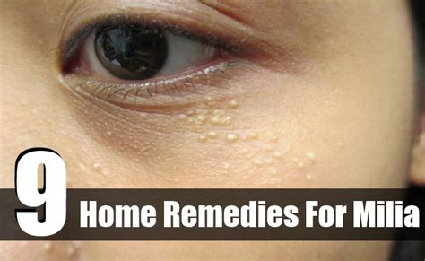 9 Home Remedies For Milia Find Home Remedy And Supplements