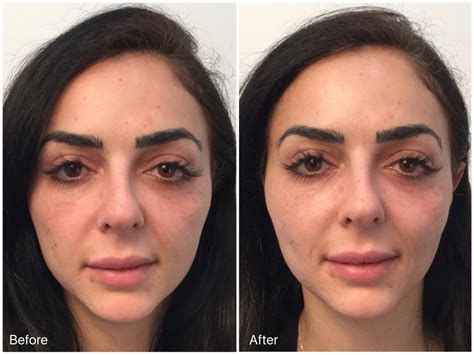 Threading Facelift Before And After Pea Vie