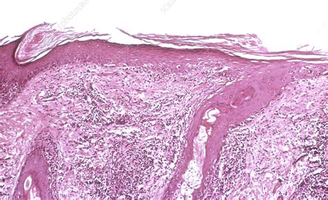 Chronic Discoid Lupus Erythematosus Light Micrograph Stock Image