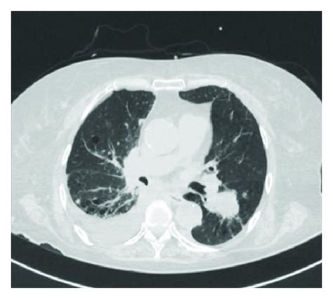 Chest Ct Scan Demonstrated Multiple Tumors In The Bilateral Lungs And A