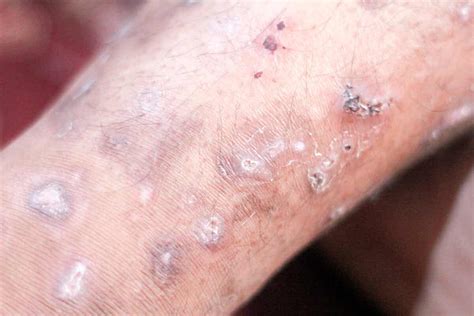 Red Spots On The Skin 25 Possible Causes And Treatments