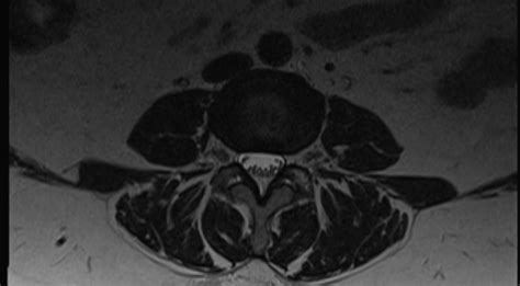 Atypical Vertebral Pedicle Hemangioma Image