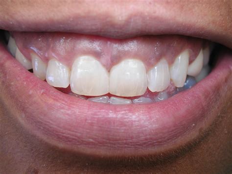 What's your favorite bondi song. White Fillings and Bonding