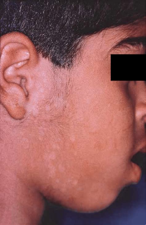 Tinea Versicolor On Face Of 5 Year Old Boy With Kidney Transplant