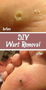 Images of Wart Removal Home Remedies Freezing