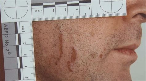 Scratch Marks On Accused Killers Face Typical Of Fingernail Scratches