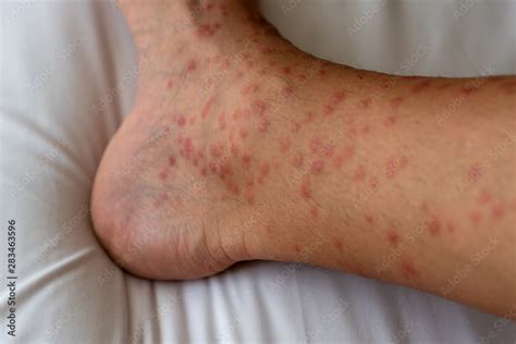 Foto De Close Up Of Redness Itching And Swelling After Many Mosquitos