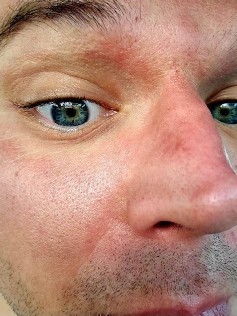 Malar Rash With Scales Going Around Eyes And Eyes Lupus Uk