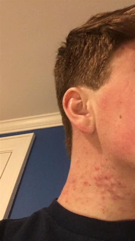 Help With Really Bad Neck Acne Both Sides Of My Neck Have Broken Out