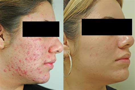 Before And After Photos Of Skin And Acne Treatments Readers Digest