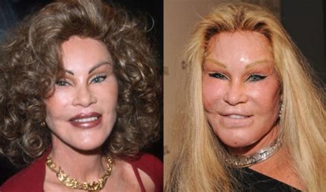10 Plastic Surgery Gone Wrong Before And After Photos Celebrity