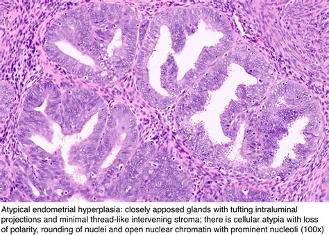 Pathology Outlines Endometrial Hyperplasia Endometrioid