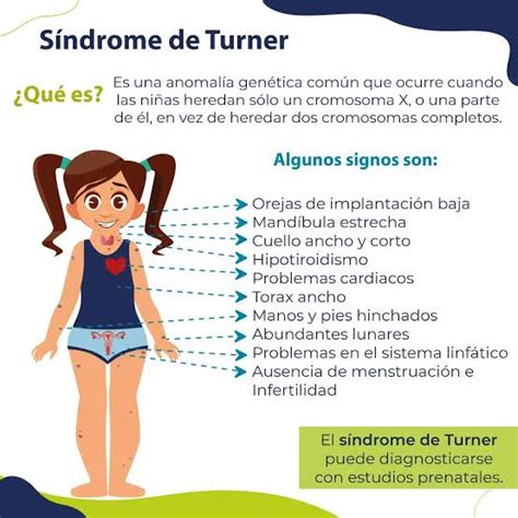 El De Agosto Es D A Mundial Del S Ndrome De Turner El Clar N