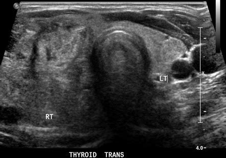 Multinodular goiter | Image | Radiopaedia.org