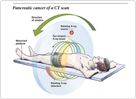 By using this site, you agree. Pancreatic Cancer Diagnosis | Modern Cancer Hospital ...