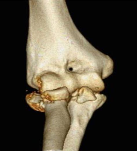 Terrible Triad Injury Of Elbow Trauma Orthobullets