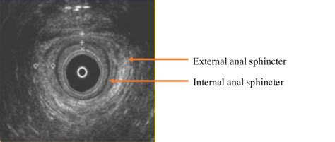 Endoanal Ultrasound Intact Perineum Used With Permission Of Eva Uustal Download Scientific
