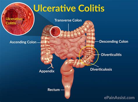Pictures of Biologics For Ulcerative Colitis Side Effects