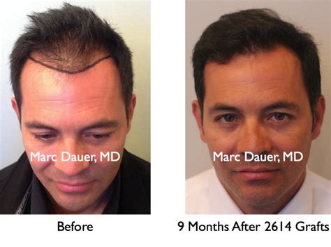 Top Hair Transplant Clinics In The Usa