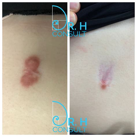 Keloid Scar Treatment Removal London Surrey Dr H Consult